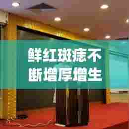 鲜红斑痣不断增厚增生，鲜红斑痣会变厚吗 