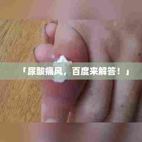 「尿酸痛风，百度来解答！」